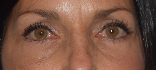 Blepharoplasty