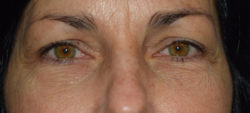 Blepharoplasty