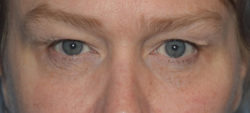 Upper Eyelid Blepharoplasty