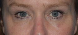 Upper Eyelid Blepharoplasty