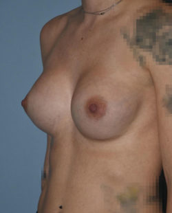 Breast Augmentation