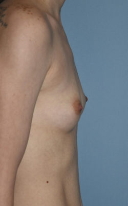 Breast Augmentation