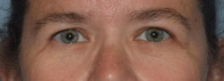 Upper Eyelid Blepharoplasty