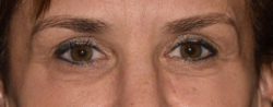 Upper Eyelid Blepharoplasty