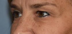 Upper Eyelid Blepharoplasty