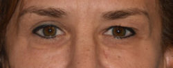 Upper Eyelid Blepharoplasty