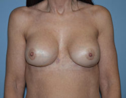 Breast Revision surgery