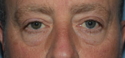 Lower Eyelid Blepharoplasty