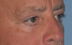 Lower Eyelid Blepharoplasty