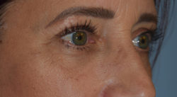 Blepharoplasty