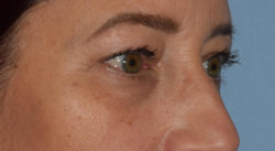 Blepharoplasty