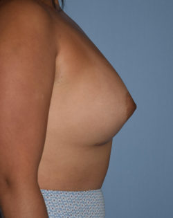 Breast Augmentation