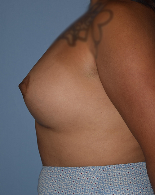 Breast Augmentation