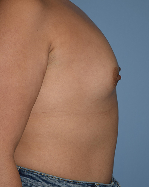 Breast Augmentation