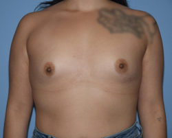 Breast Augmentation