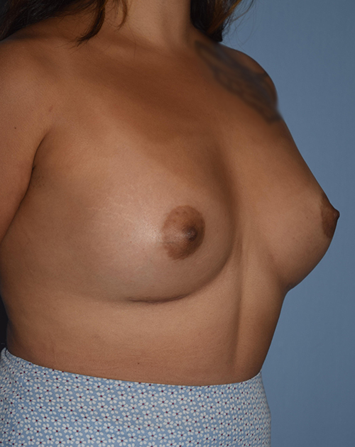 Breast Augmentation