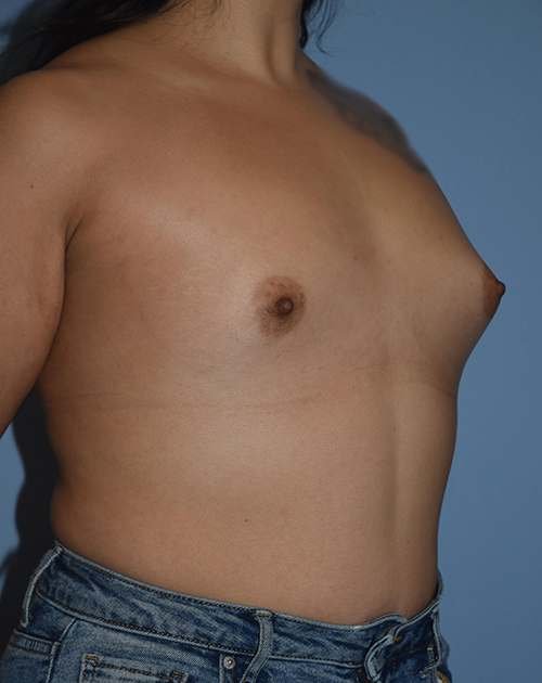 Breast Augmentation