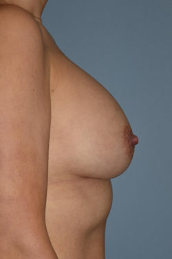 Breast Augmentation