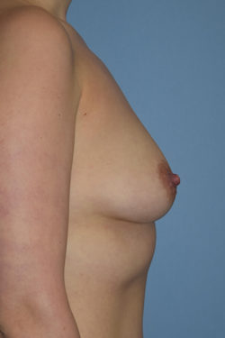 Breast Augmentation