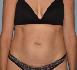 Tummy Tuck