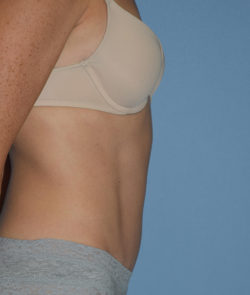 Tummy Tuck
