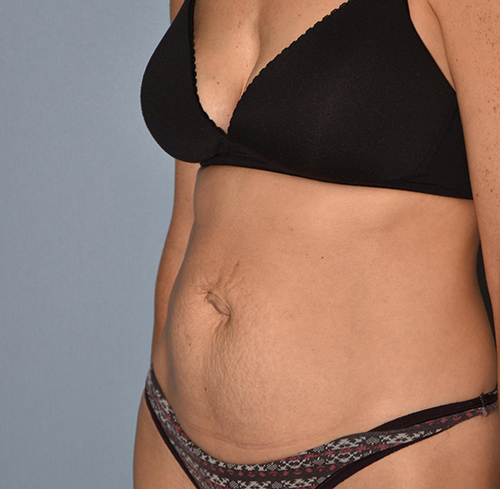 Tummy Tuck