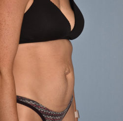 Tummy Tuck