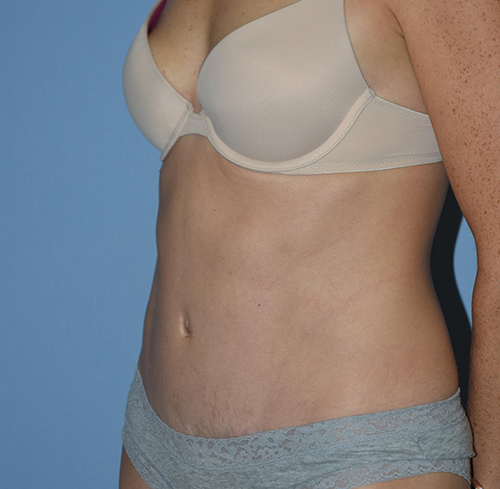 Tummy Tuck