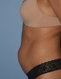 Tummy Tuck