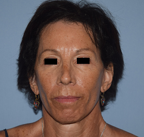 Facelift results Long Island