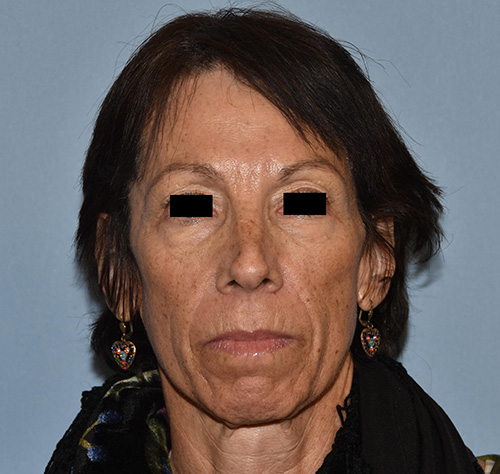 Facelift results Long Island