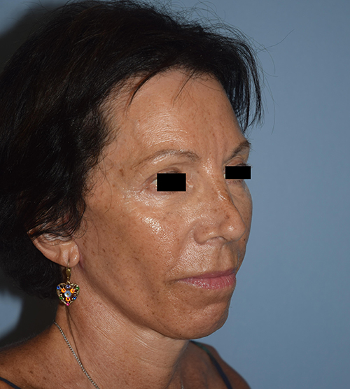 Facelift
