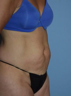 Tummy Tuck