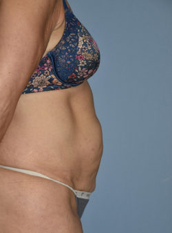 Tummy Tuck