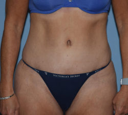 Tummy Tuck