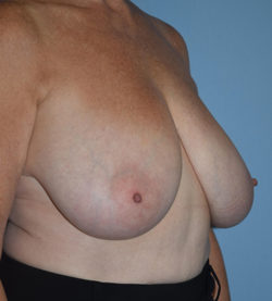 Breast Lift