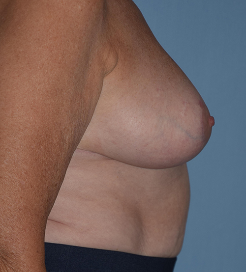 Breast Lift