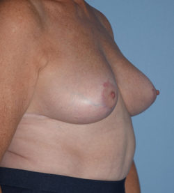 Breast Lift