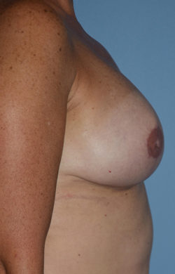 Breast Reconstruction (Implants)