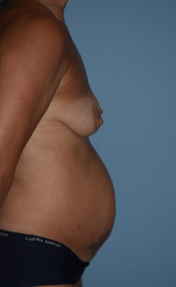 Breast Reconstruction (Implants)