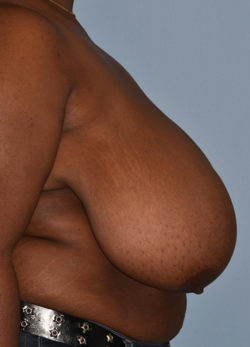 Breast Lift