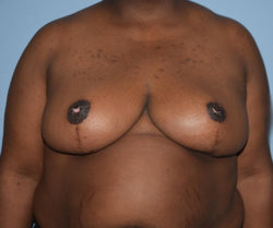 Breast Lift