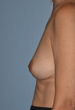 Breast Reconstruction (Implants)