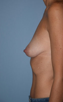 Breast Reconstruction (Implants)