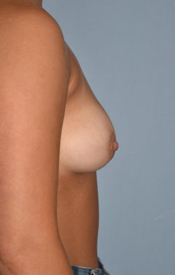 Breast Lift
