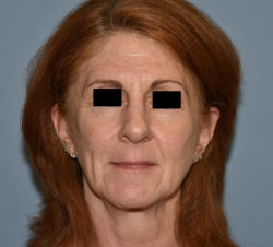 Facelift