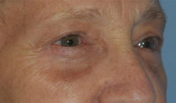 Blepharoplasty