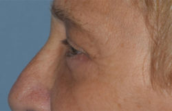 Blepharoplasty