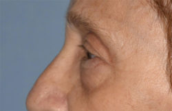 Blepharoplasty