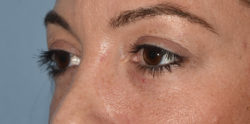 Upper Eyelid Blepharoplasty